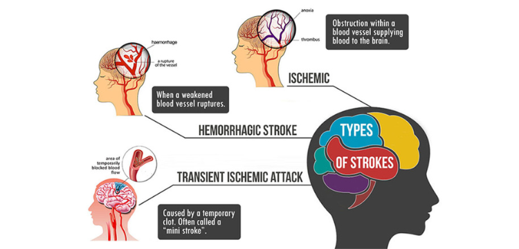 Understanding Different Types of Strokes: Its Symptoms and Causes