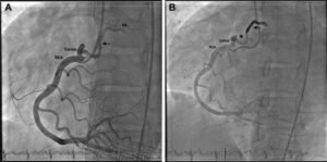 Is Percutaneous Coiling Safer Than Surgery?