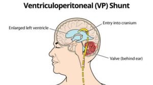 What is a VP Shunt Used For?