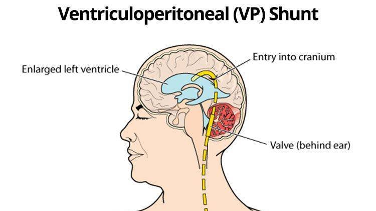 What is a VP Shunt Used For?