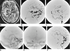 How Long Does Recovery Take After Percutaneous Coiling?