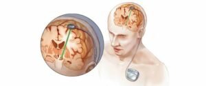 Deep Brain Stimulation (DBS) for Parkinson’s – Treatment, Benefits & Risks