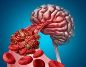 Why Brain Clots Are Becoming More Common: What You Should Know