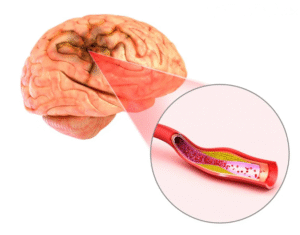 Brain Aneurysms: What Are its Causes, Symptoms, and Treatment?