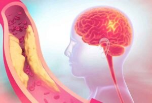 Carotid Artery Disease: What Are Its Symptoms, Diagnosis, and Treatment?