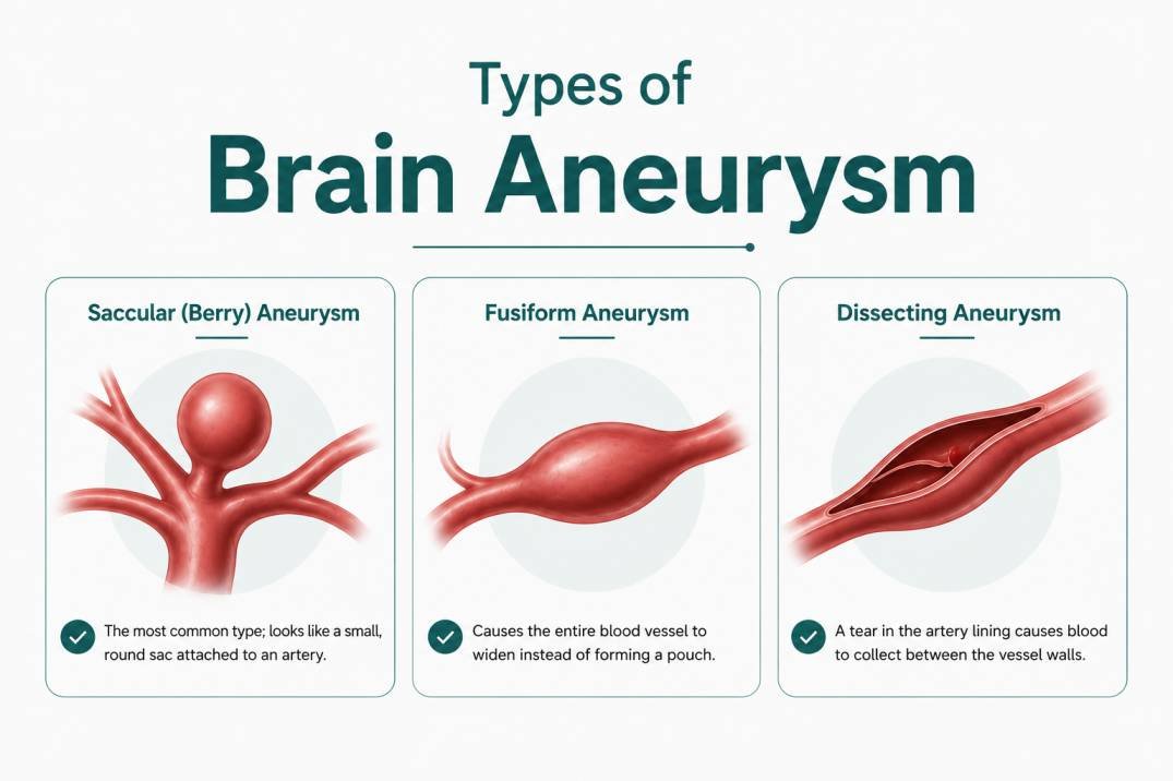 Types of Brain Aneurysm