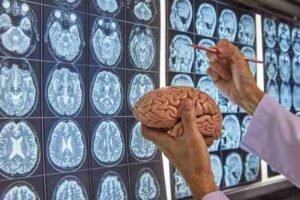 Common Neurosurgery Myths Debunked: Facts You Should Know