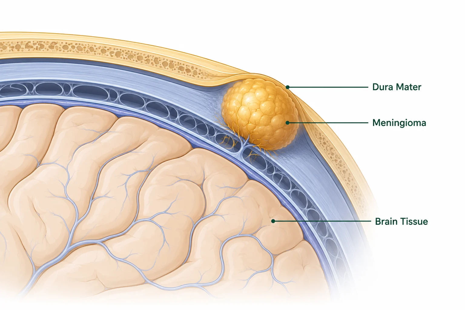 Meningioma Treatment in Delhi. Best Neurosurgeon in Delhi