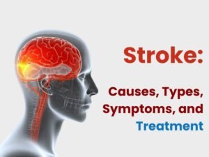 Stroke: What Are Its Causes, Types, Symptoms, and Treatment Options?