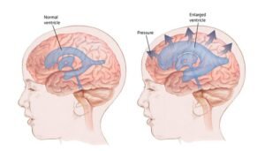 VP Shunt Surgery: Causes, Procedure, Recovery & Risks