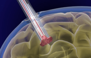 What Are the Pros and Cons of Minimally Invasive Brain Tumor Removal?