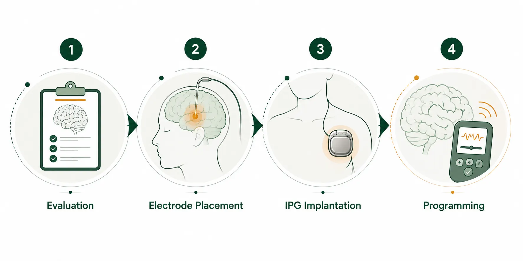 Four-step infographic showing the DBS surgery process from evaluation to programming. 