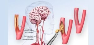 How Serious is Carotid Artery Surgery?