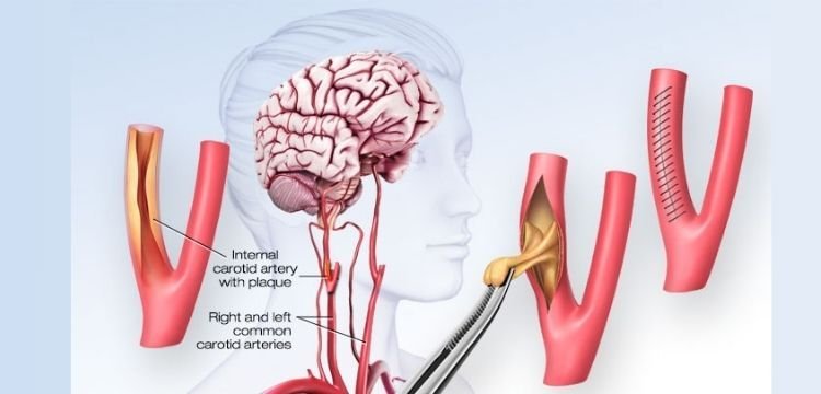 How Serious is Carotid Artery Surgery?