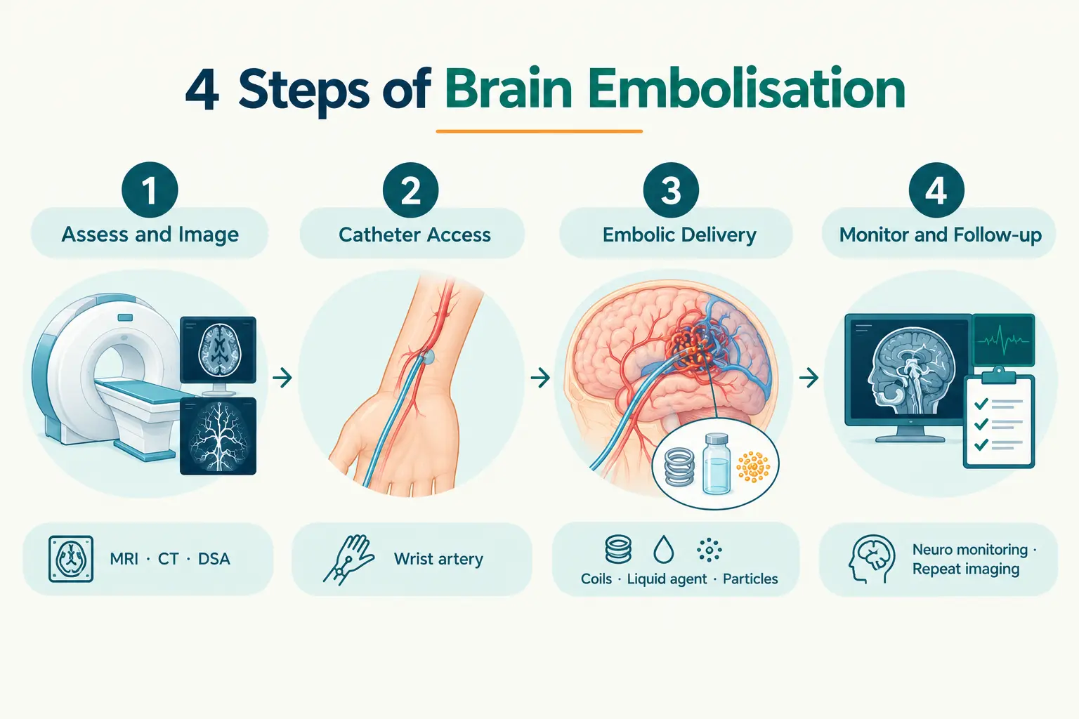 Four-step infographic showing brain embolisation from imaging and catheter access to embolic delivery and follow-up