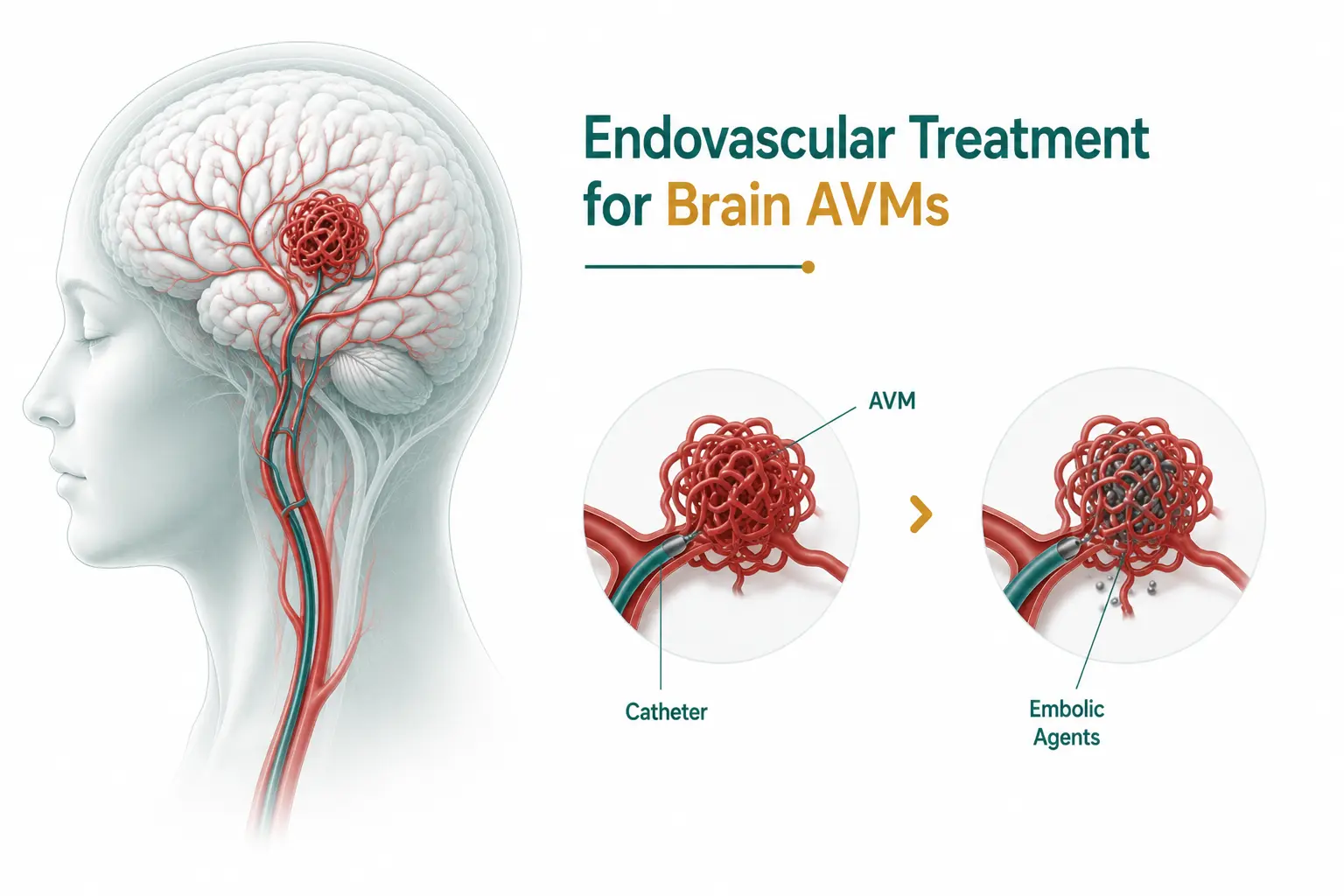 Endovascular Treatment for Brain AVMs in Delhi