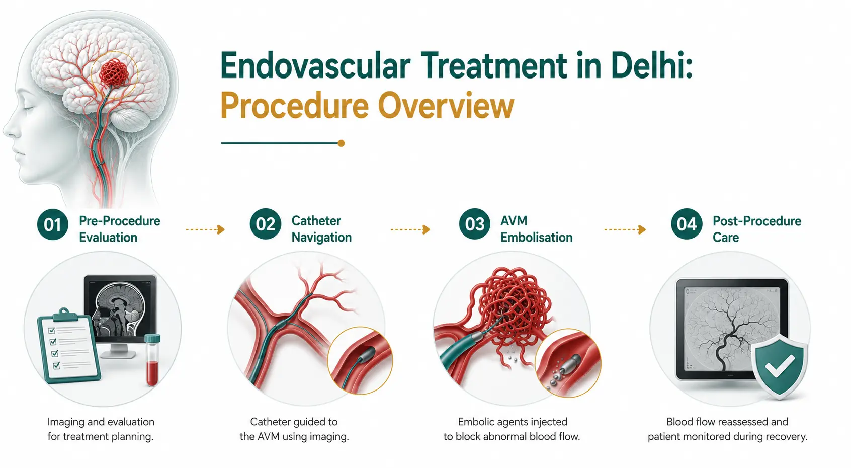 Endovascular Treatment in Delhi