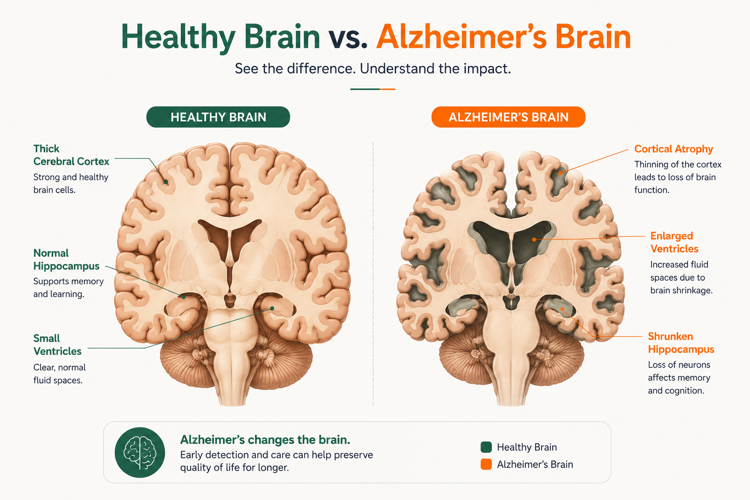 Healthy brain versus Alzheimer's affected brain - showing cortical shrinkage and memory centre damage