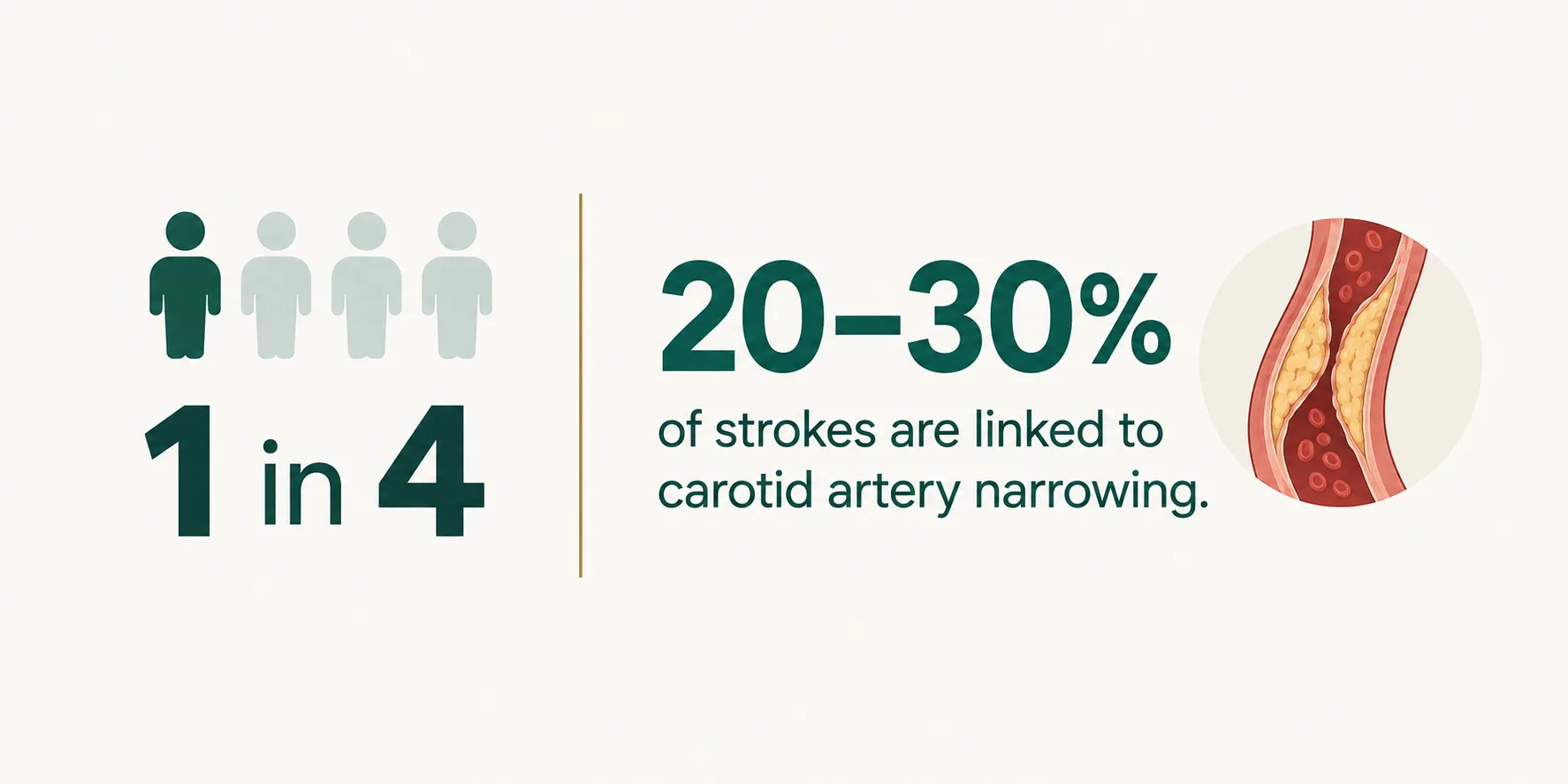 Stroke is linked to carotid artery narrowing statistics