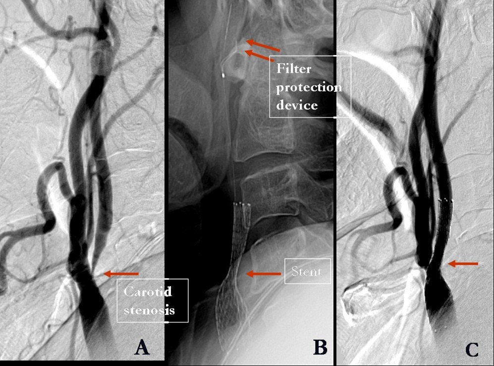 A: severe stenosis at the origin of the right ICA. B: stent and filter protection device across the stenosis. C: good re-opening of the artery after stenting.