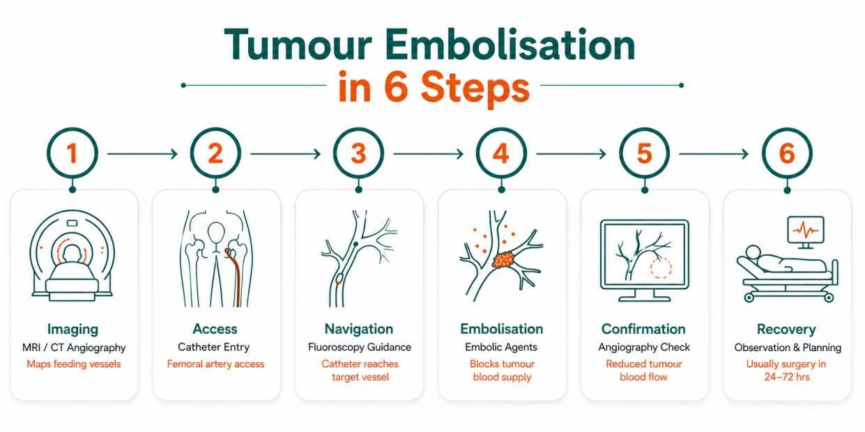 Step-by-step infographic showing the tumour embolisation procedure from imaging to recovery