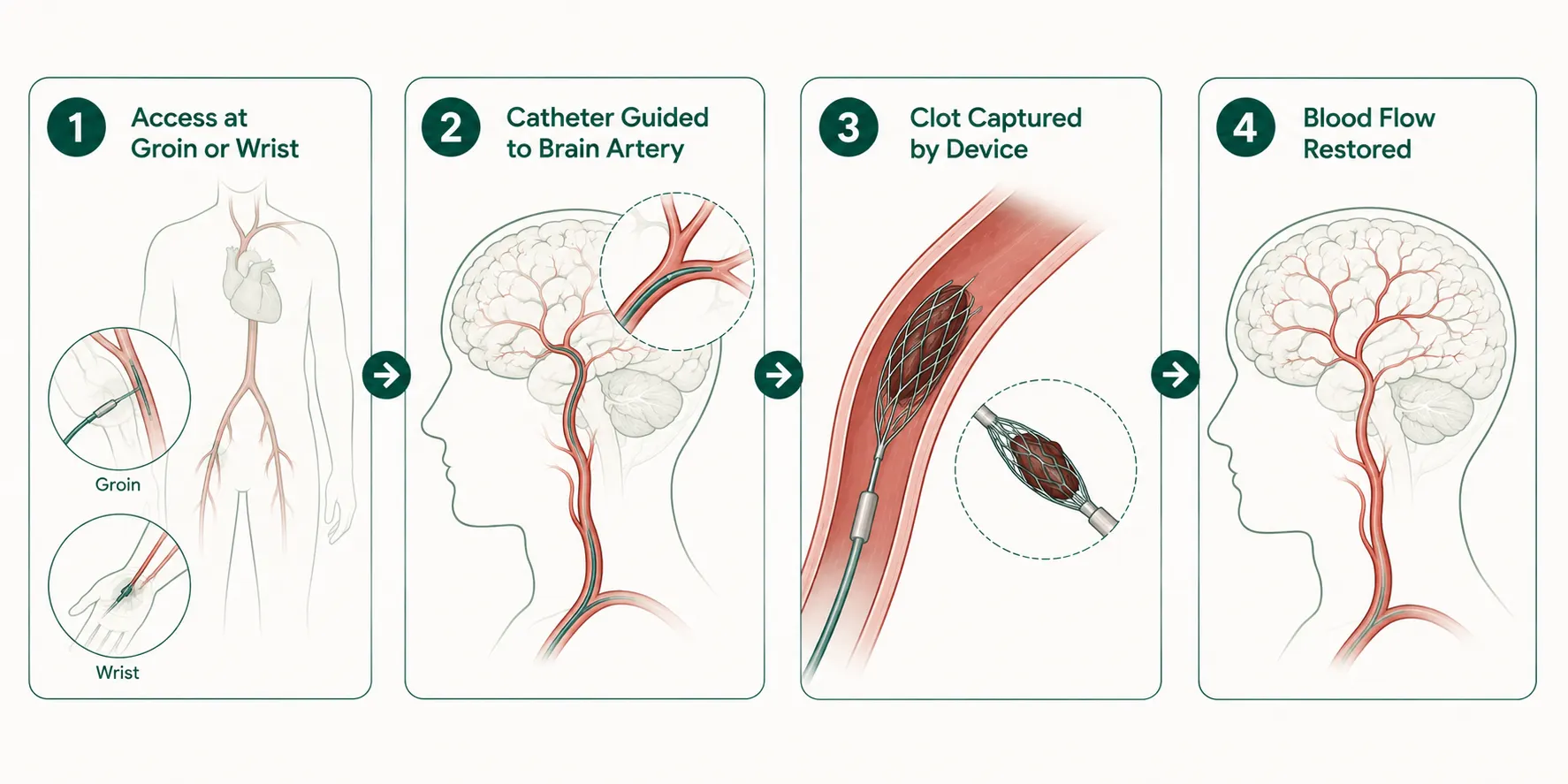 Infographic showing the four steps of mechanical thrombectomy for stroke treatment.