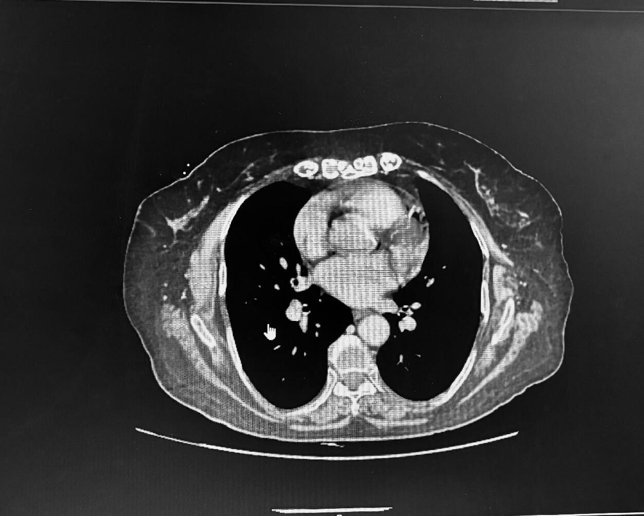 Pre-operative CT Scan showing the extent of vertebral collapse at L2 and L4 before surgery.