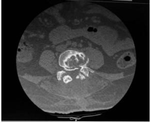 CT scan showing retained implant at L4-L5 and the extent of bony changes from previous surgeries