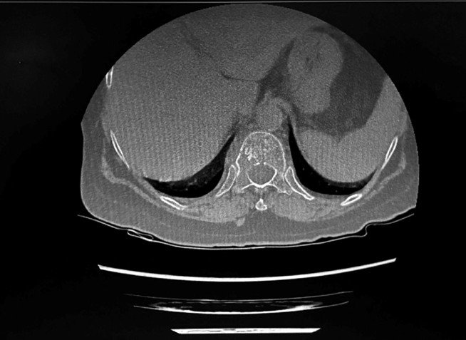 CT scan confirming pathological fracture of D11 due to a lytic lesion
