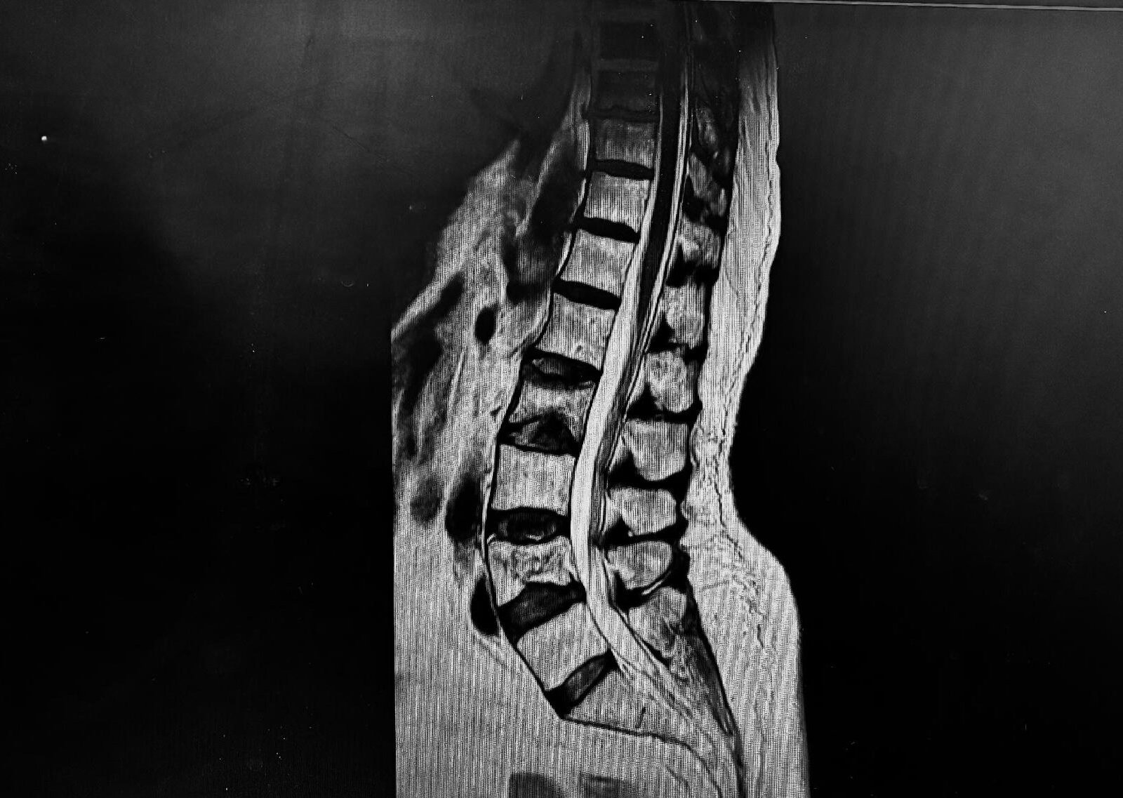 Pre-operative MRI showing fractured and collapsed vertebrae at L2 and L4 with endplate depression.