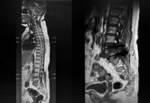 MRI showing the L4-L5 level with scar tissue formation and nerve compression on the right side