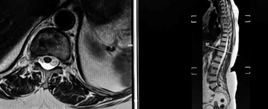 D11 lesion with vertebral involvement and additional disc changes at the lumbar spine