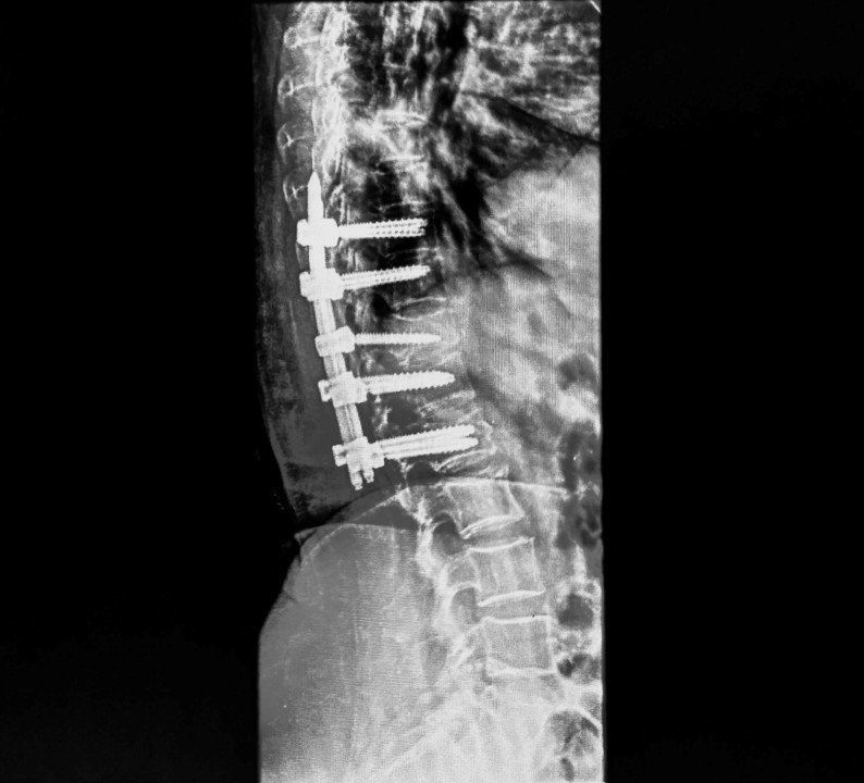 X-ray confirming pedicle screws in correct position