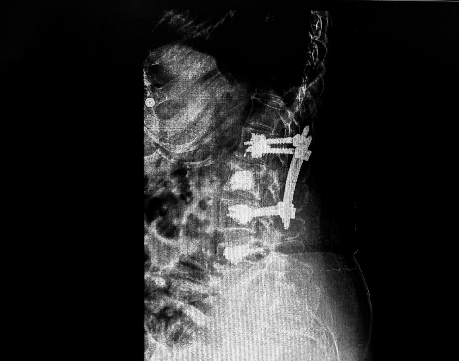 Post-operative X-ray confirming cemented screw and rod fixation with kyphoplasty at L2 and L4.