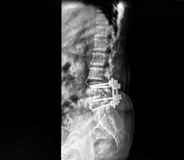 Post-operative X-ray confirming implant removal and the re-explored L4-L5 level