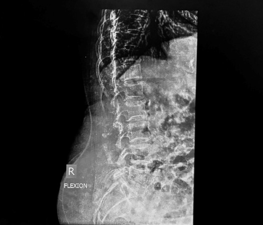 minimal invasive spine surgery
