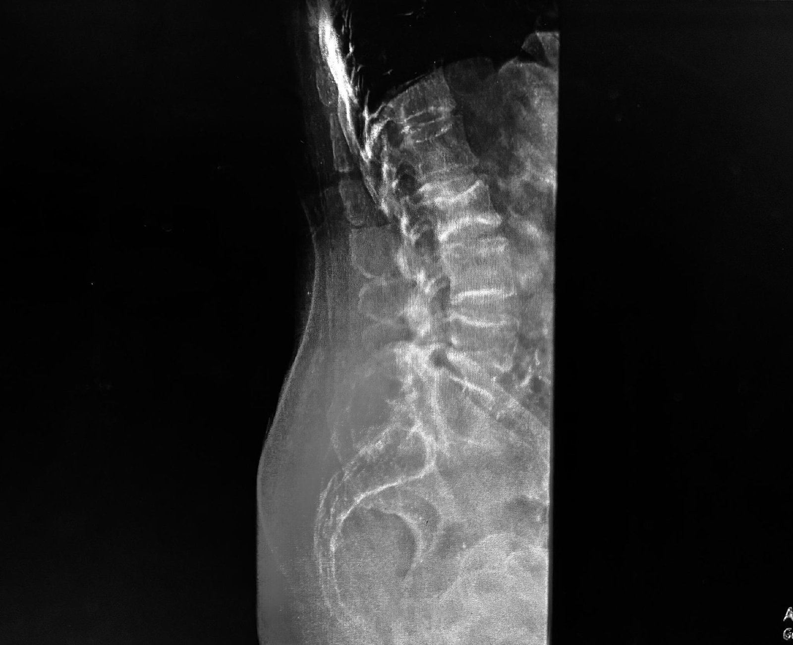 Pre-operative X-ray: X-ray on arrival showing collapsed vertebrae at L2 and L4.