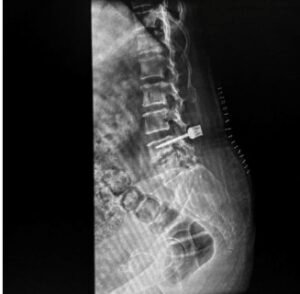 X-ray showing the previously operated spine with retained implant at L4-L5