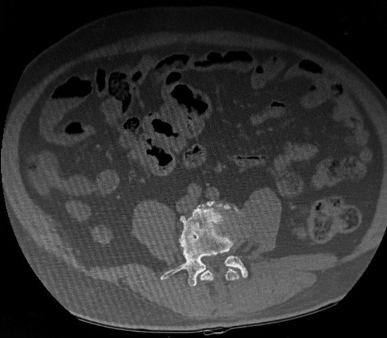 CT scan showing a transitional vertebra at the lumbosacral junction and Schmorl's node at L5