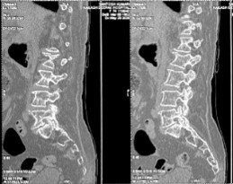 CT scan showing reduced disc height at L5-S1 with endplate irregularities and sclerosis, signs of long-standing degenerative change.
