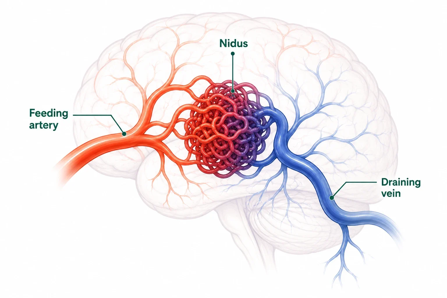 Illustration of a brain AVM showing feeding artery, nidus, and draining vein. Brain AVM Treatment in Delhi