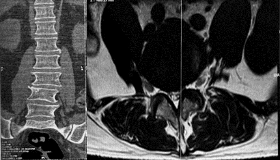 MRI showing severe disc degeneration at L4-L5 and degenerative changes at L2-L3 and L3-L4.