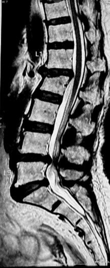 MRI showing severe disc bulge at L3-L4 with canal narrowing and bilateral nerve root compression.