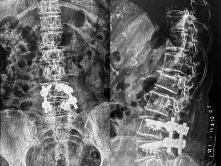 Post-operative X-ray confirming metallic rod and screw fixation correctly positioned at L3-L4.
