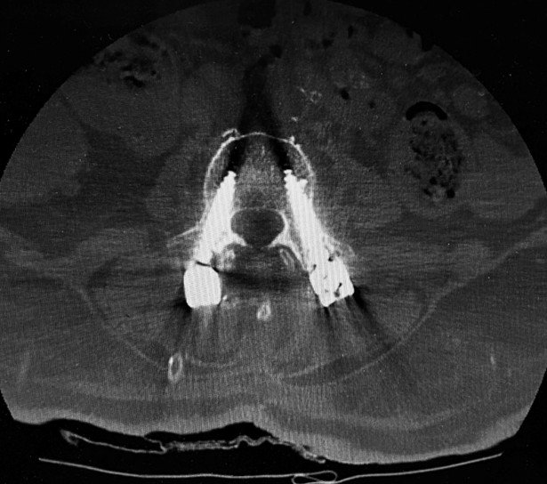 Post-operative CT scan confirming that the pedicle screws and rods are correctly placed from D12 to L3.