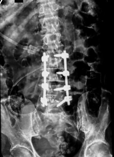 Post-operative X-ray confirming spinal fusion implants correctly positioned from L2 to L5.