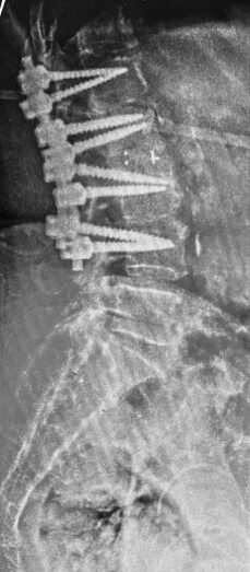 Post-operative X-ray confirming screw and rod fixation from D12 to L3, with implants correctly positioned.