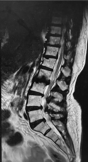 MRI showing disc prolapse at L1-L2 with nerve compression, ligamentum flavum thickening, and degenerative changes across multiple levels.