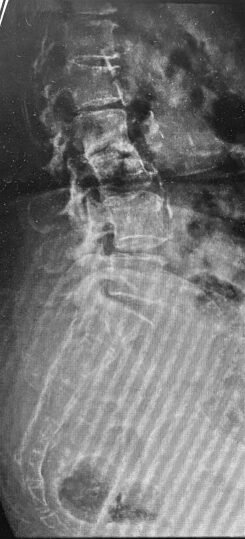 X-ray on arrival showing partial straightening of the lumbar spine and sacralisation of L5 - both signs of long-standing degenerative change.