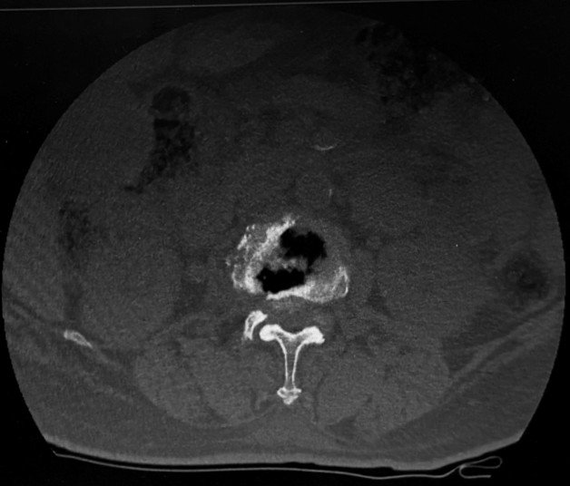 CT scan showing Schmorl's nodes and mild anterior wedge compression of D12, signs of chronic degenerative stress on the spine.